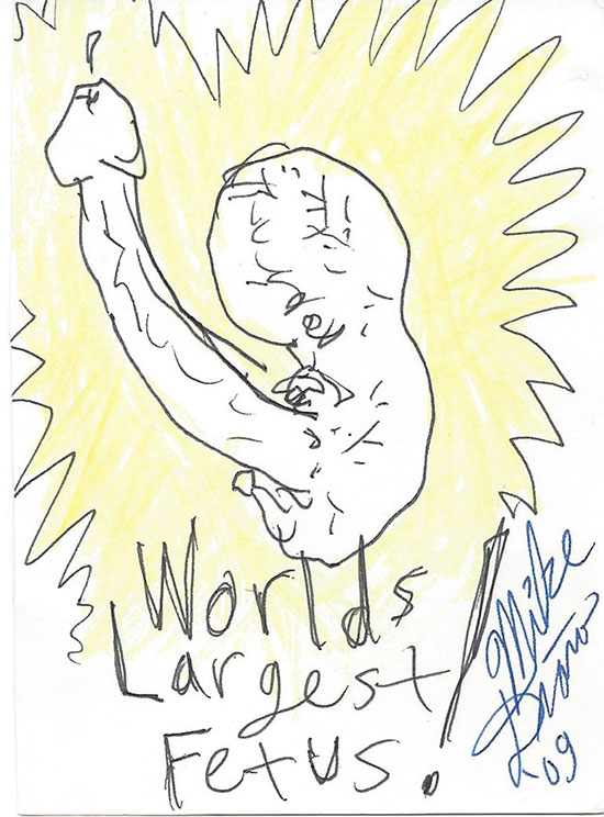 Worlds Largest Fetus!